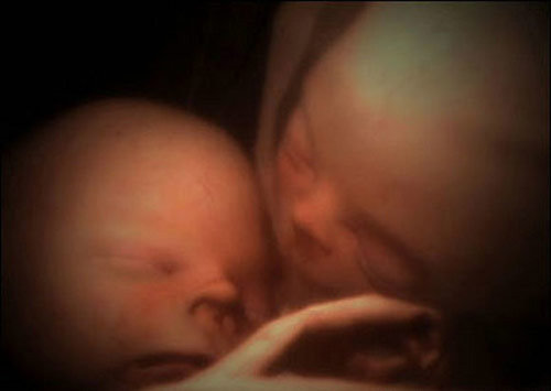 震撼！子宫里的多胞胎世界