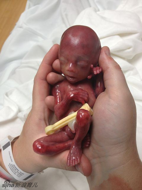 一位美籍妈妈在她的博客上公布了自己刚出生的19周早产儿,宝宝在出生