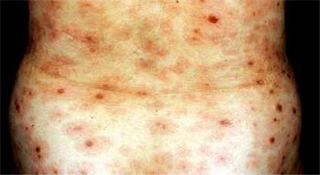 【梅毒的早期症状图片】梅毒的症状是什么样的