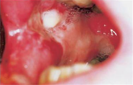 梅毒的早期症状图片 梅毒的6大症状你一定要知道!