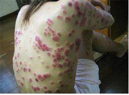 【梅毒疹特点图片】梅毒红点特征_梅毒红疹的