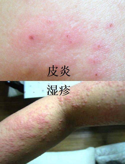 湿疹和皮炎的区别图,皮炎和湿疹用什么药治疗比较好