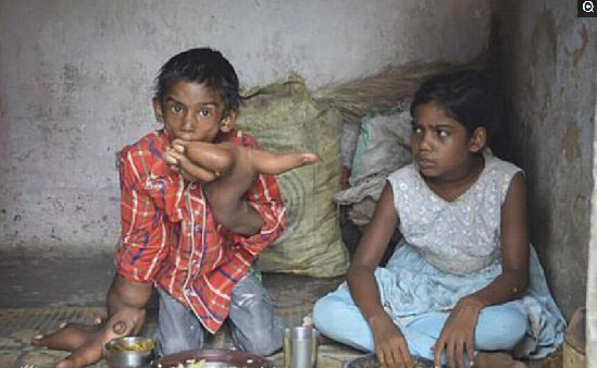 印度8岁男孩穆罕默德·卡利姆长了一双巨型大手，每只重约8公斤，长大约43厘米。