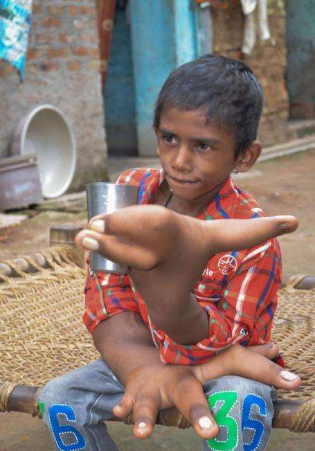 印度8岁男孩穆罕默德·卡利姆长了一双巨型大手，每只重约8公斤，长大约43厘米。