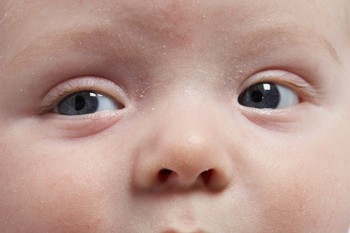 婴儿痤疮图片,新生儿痤疮图片,新生儿痤疮早期