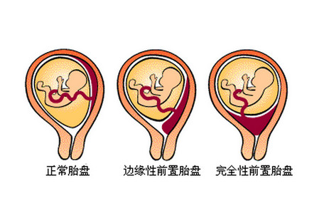 【胎盘前壁】胎盘前置_胎盘成熟度_胎盘低置_亲亲宝贝