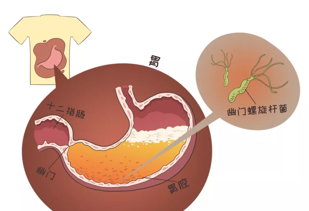 怎么预防幽门螺杆菌感染