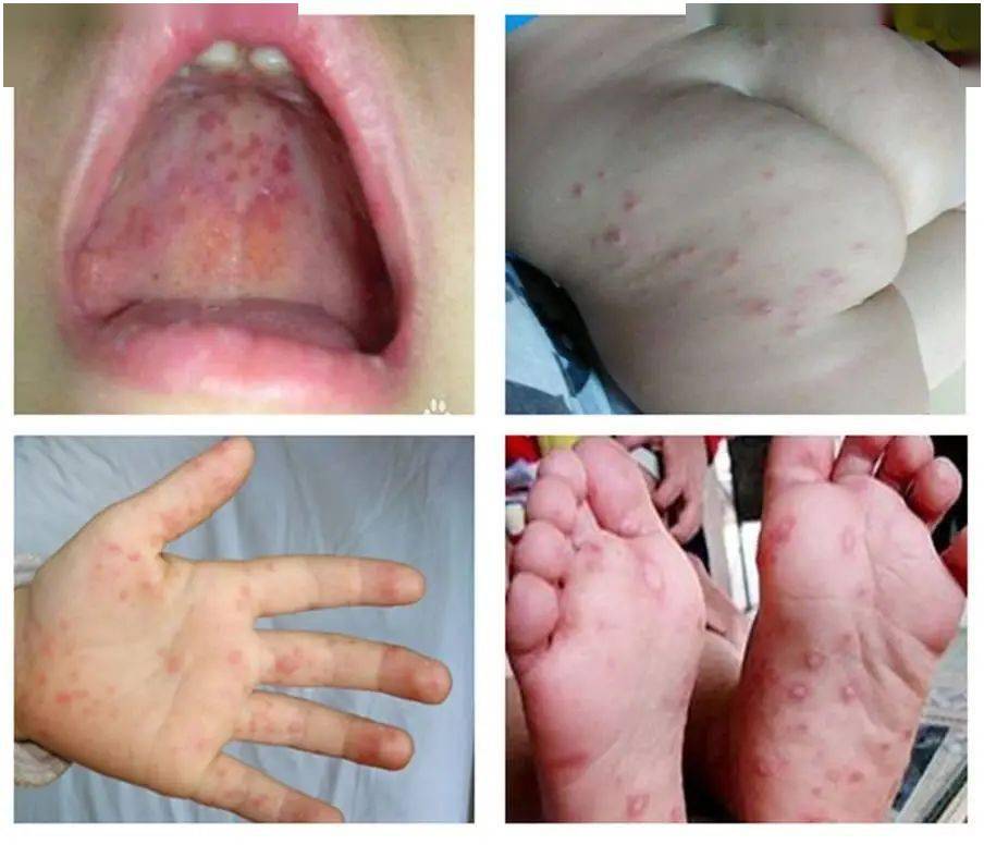 得了手足口病后会怎样? 手,足和臀部出现皮疹或疱疹,口腔内出现疱疹.