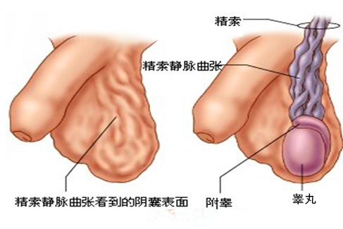 精索静脉曲张男人不育难题 如何治疗方法是要