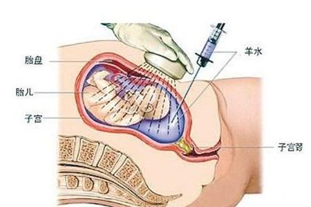 羊水功能解密量多量少都不好