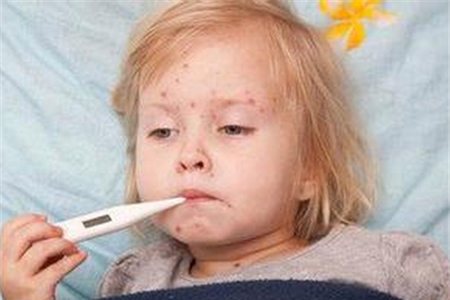 【宝宝出水痘有什么症状】宝宝出水痘的前期症