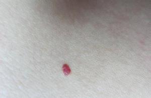 身上长小红点不痛不痒