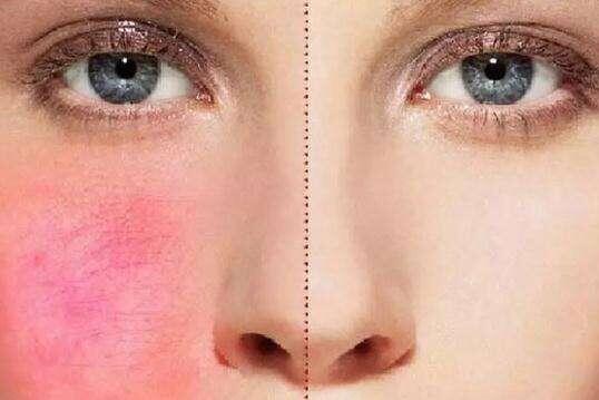 【宝宝眼睛有红血丝怎么回事】宝宝眼睛有红血