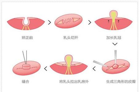 乳头内陷没有奶怎么办 这些办法让你不烦恼