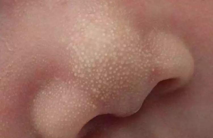 新生儿鼻子上长很多小白点是怎么回事