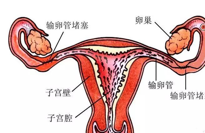 备孕汗蒸能治疗输卵管堵塞吗