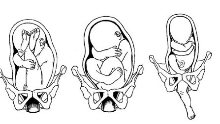 这4种不良胎位会造成难产