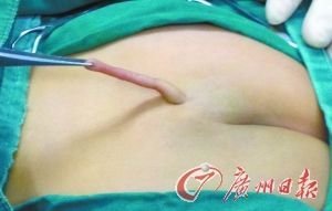 女婴屁股上为什么长尾巴？隐性脊柱裂还是返祖？