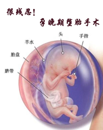 实拍堕胎手术全过程 孕晚期堕胎手术很残忍