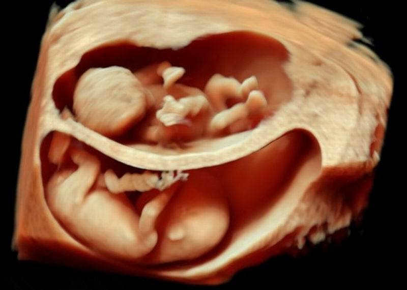 双胞胎胎儿发育图3D