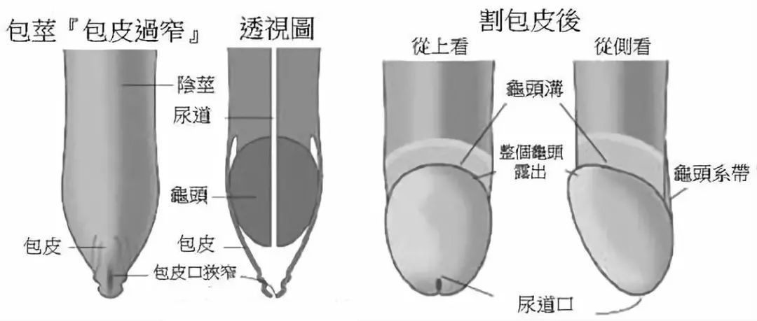 龜頭嵌頓會不會自己撐大