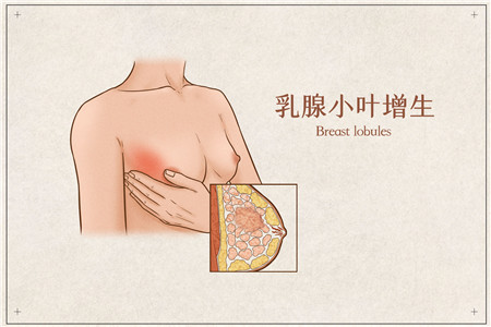 小叶增生症状2