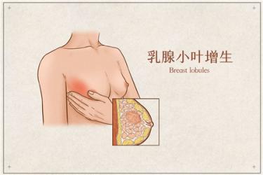 小叶增生症状2