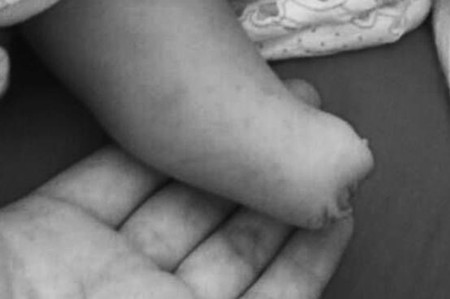 孕妇产检7次B超医生均说正常 孩子出生后无右脚