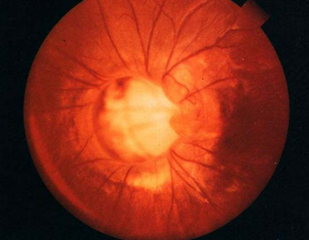 早产儿视网膜病变能治好吗