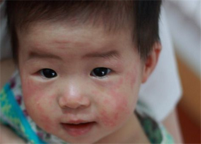 宝宝风疹是怎么引起的？