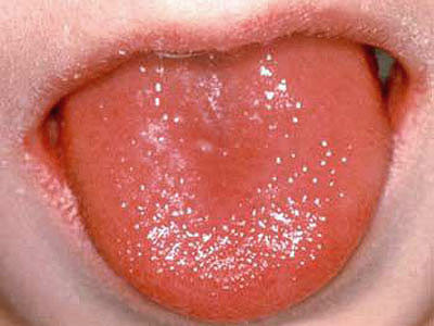 小孩草莓舌