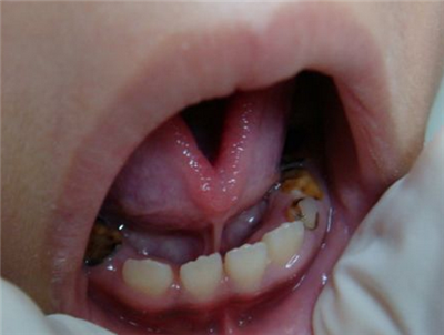 儿童龋齿发病率是多少？