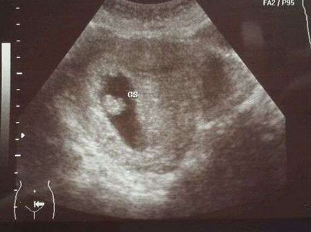 怀孕6周可以看见胎心胎芽吗