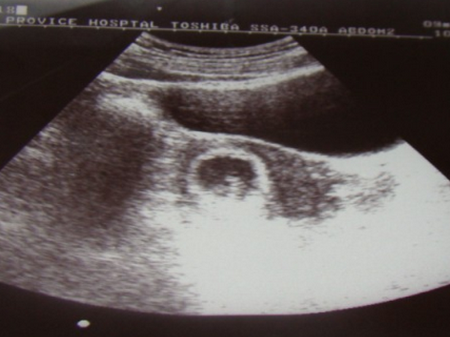 怀孕7周胚芽多大正常