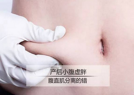 产后小腹虚胖  可能是腹直肌分离惹的祸