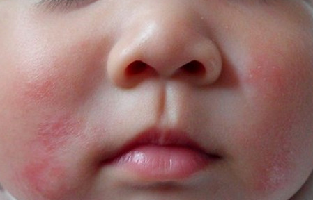 宝宝湿疹要分型对症处理，你知道怎么区分吗？