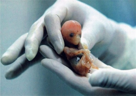 胎芽胎心