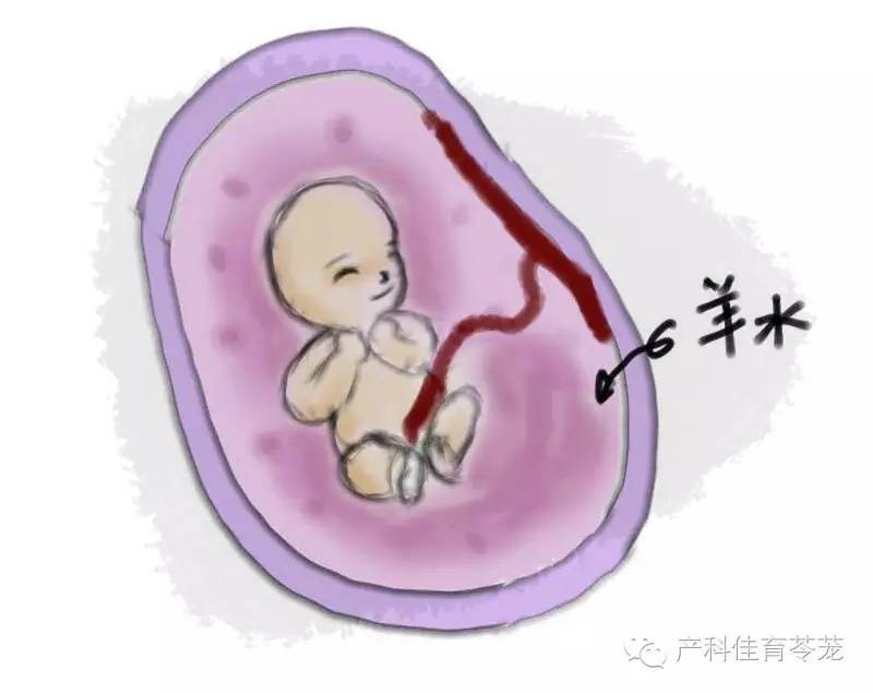 羊水过多过少都是问题 咋整？