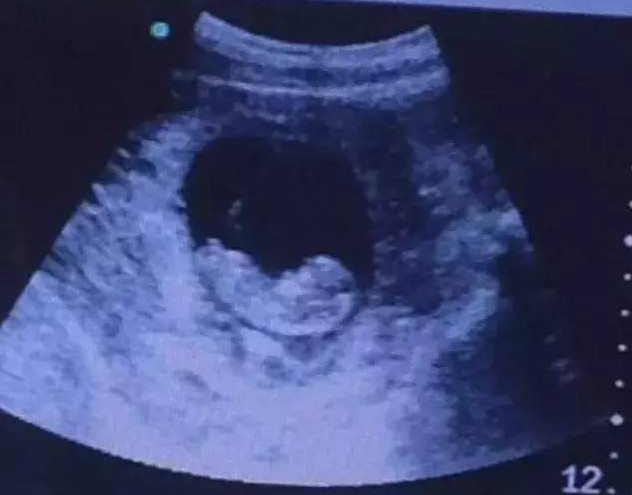 一张胎儿照片，竟被点击百万次，引来无数争议！