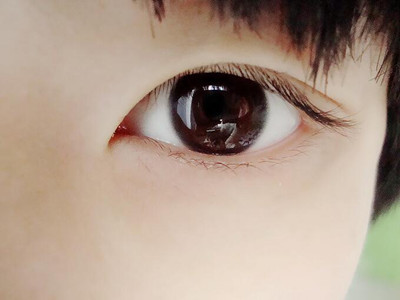 近视眼手术利与弊