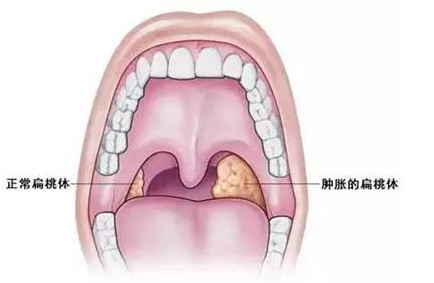 扁桃体和阑尾切除有助生育？