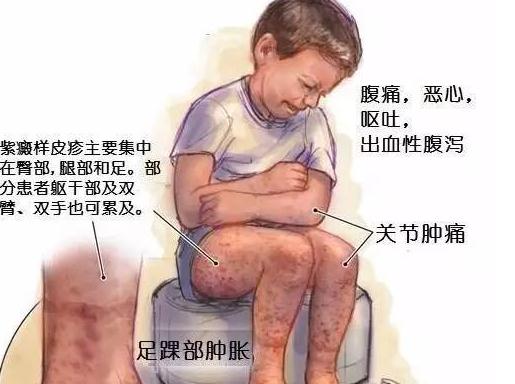 过敏性紫癜，离我们并不遥远