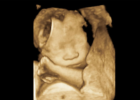 宝宝的第一张照片——三维彩超，让你一分钟就看得懂！