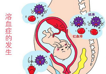 关于宝宝ABO溶血症，O型血的妈妈一定要看看！