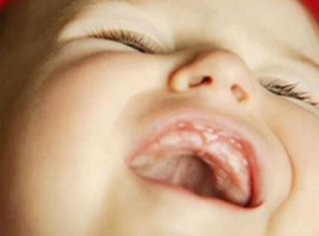 新生儿的马牙、雪口和螳螂齿儿，是不是该治疗的三种病？