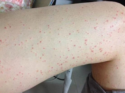 过敏性紫癜腹型症状