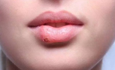 亲吻是会传播疱疹，那如何不让它威胁到你的宝宝？
