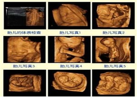 四维彩超检查什么