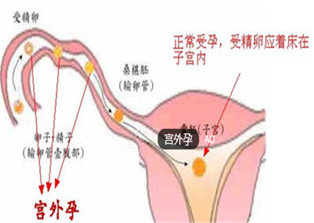 宫外孕手术后多久可以要孩子 宫外孕手术后什么时候可以再怀孕 亲亲宝贝网