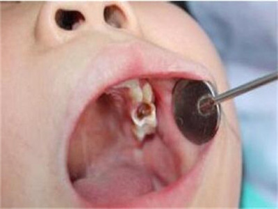 儿童龋齿不治疗可以吗